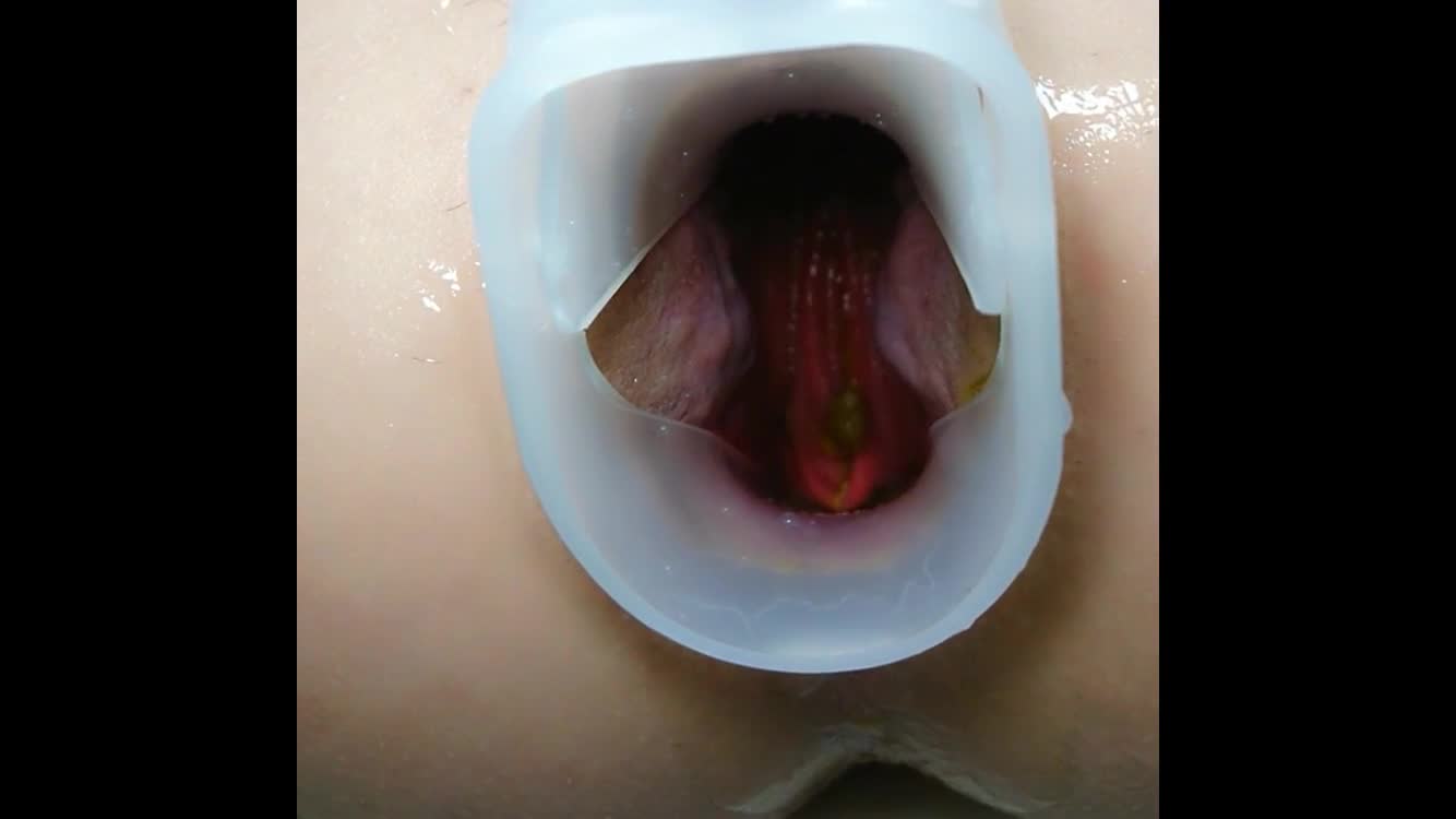 115 扩张器特写看菊花内